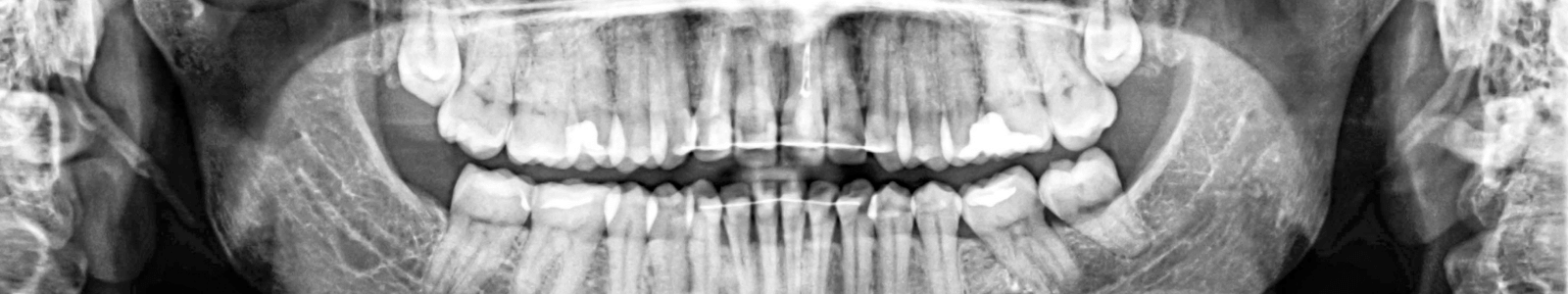 panoramic dental x-ray