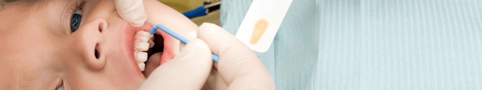 fluoride varnish application